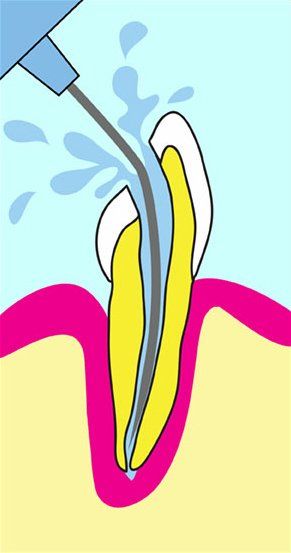 Tooth cross-section being irrigated with water from a tool during a dental procedure.