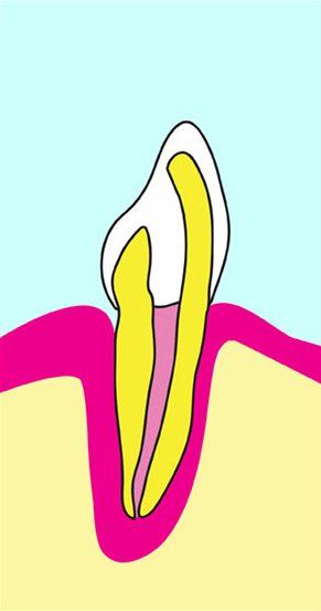Diagram of a tooth, yellow root canals, white enamel, pink gumline, and surrounding light blue and yellow areas.