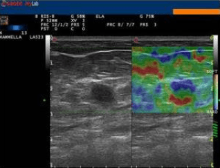 L'elastosonografia