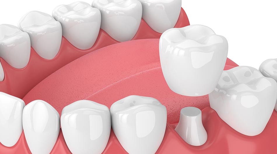 dental crowns - Rochester MN