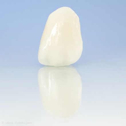 Veneers können individuell ästhetisch gestaltet werden. Veneers können individuell ästhetisch gestaltet werden.