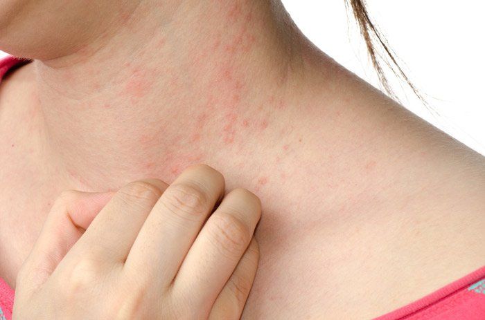 A Lady With Dermatitis