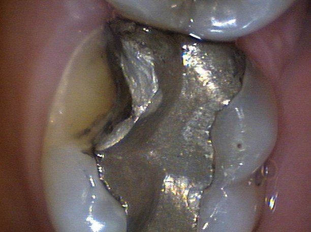 broken tooth