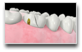 Crown Lengthening
