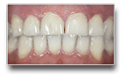 Home Bleaching