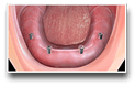 Implant Denture