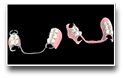 Implant Denture