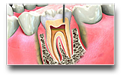 Root Canal