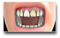 Veneer