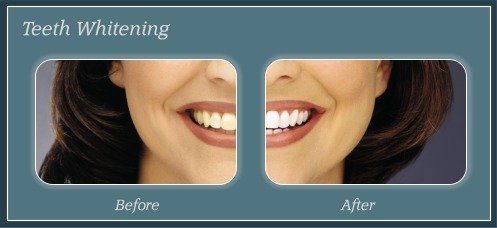 Teeth Whitening