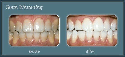 Teeth Whitening