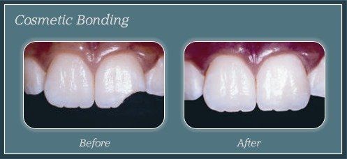 Teeth Whitening