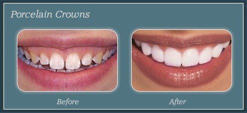 Porcelain Crowns
