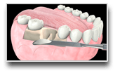 Bone Grafting