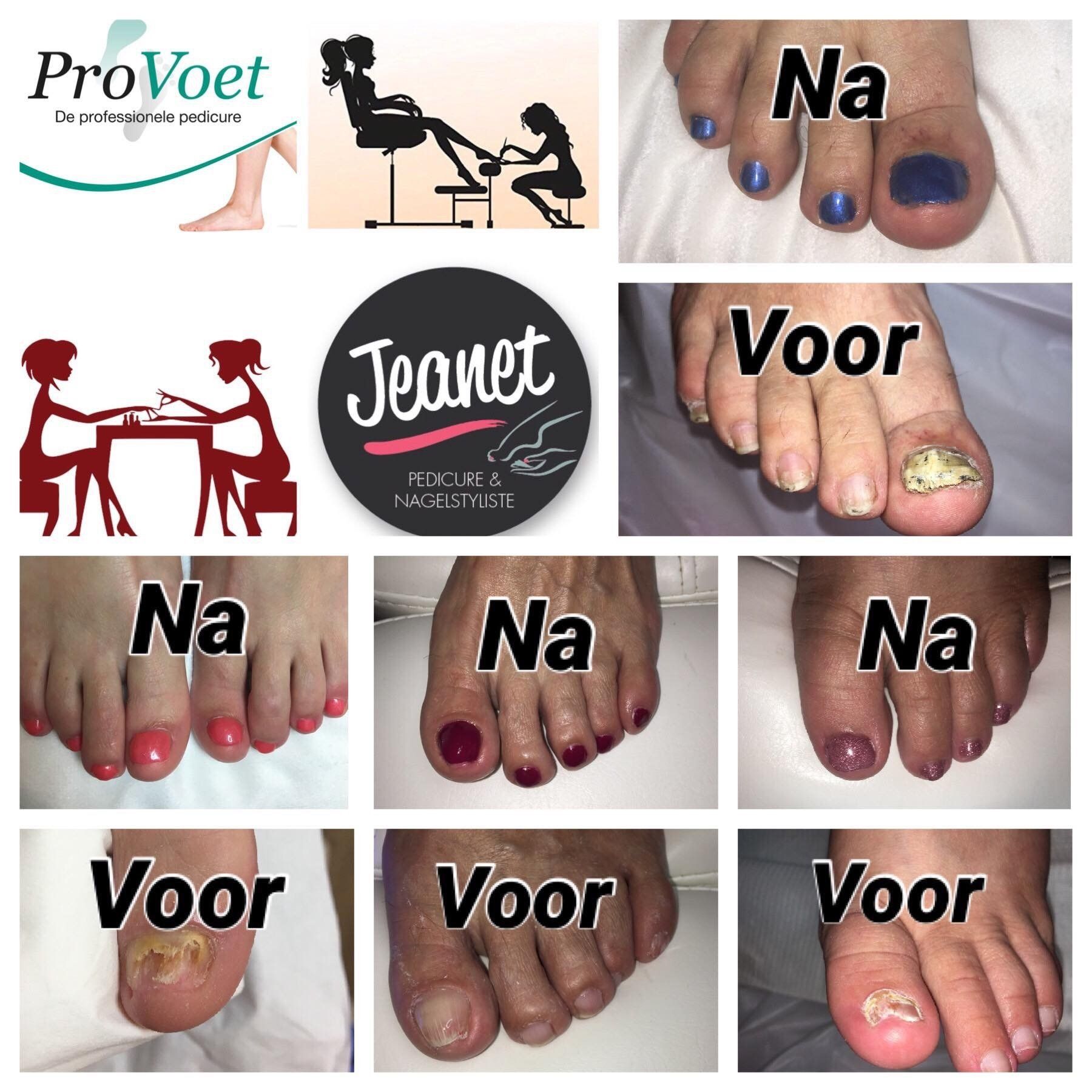 Collage van voor- en na-foto's van teennagels en logo's van klinieken die de resultaten van nagelbehandelingen laten zien.