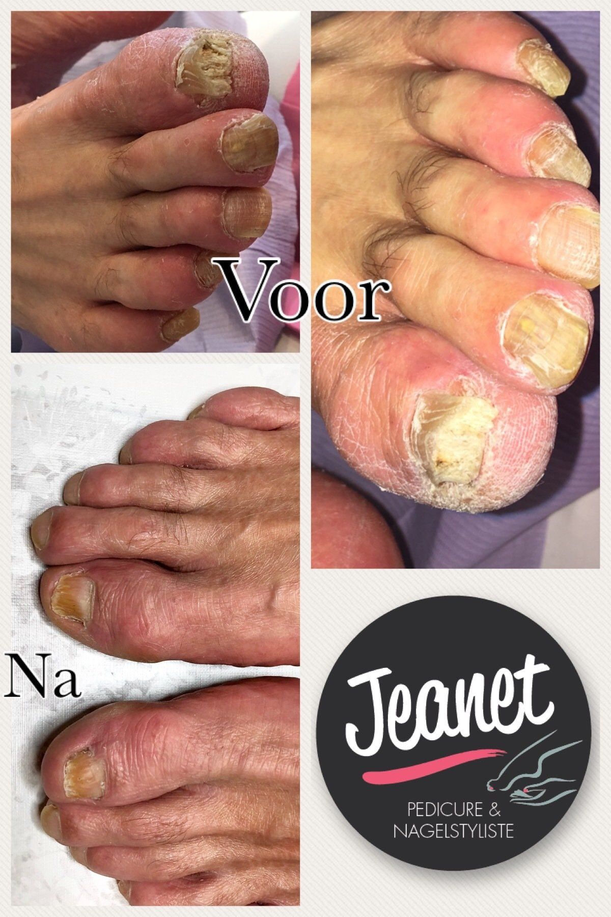 Voor- en na-foto's van verdikte, gele teennagels met de opschriften