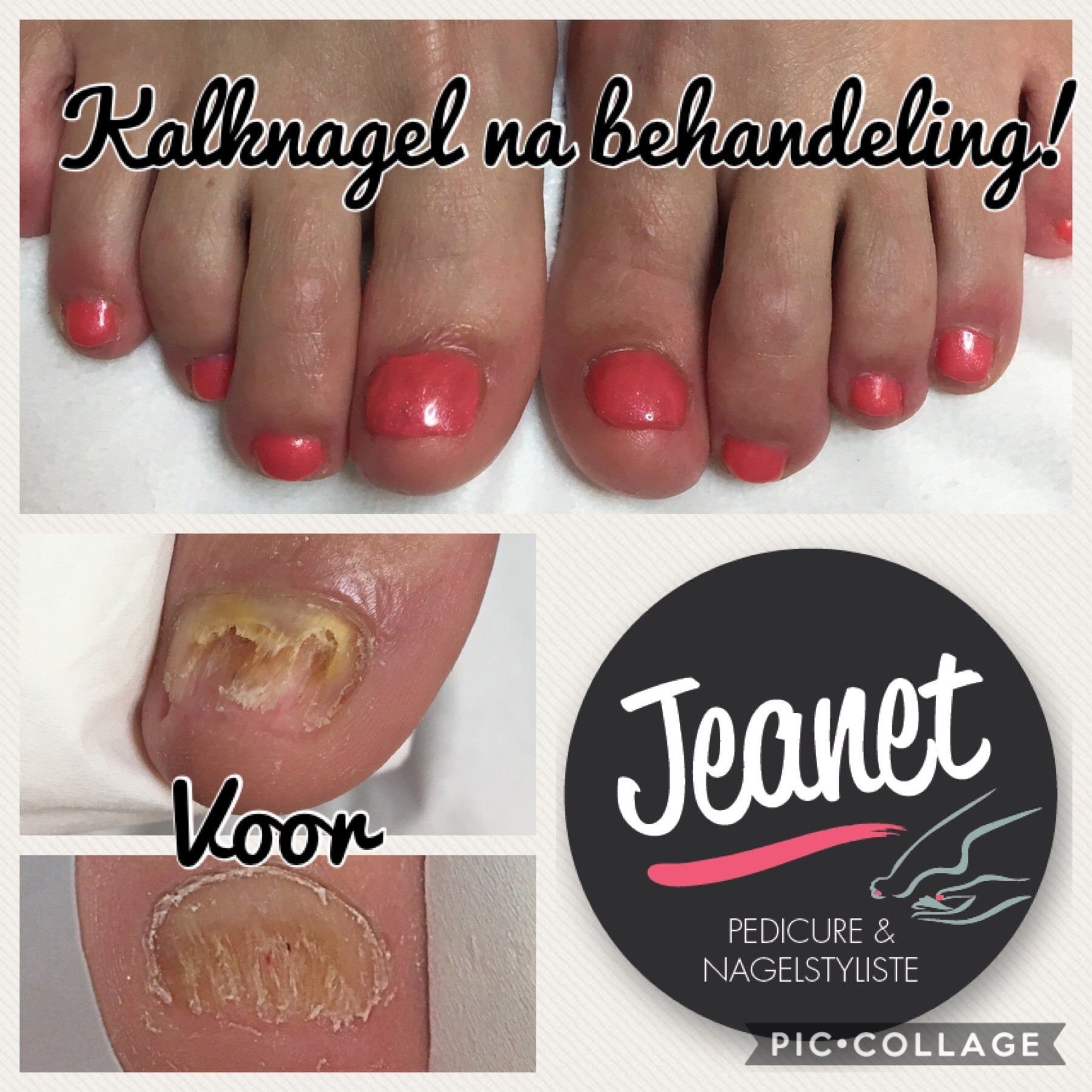 Kaalnagel na behandeling met roze gelakte tenen en close-up van verdikte nagel vóór behandeling
