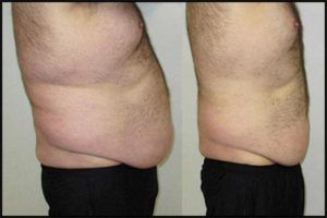 Lipo Melt Before & After