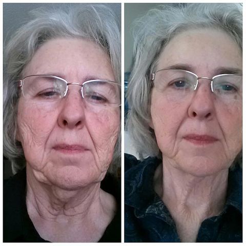 Lipo Melt Before & After