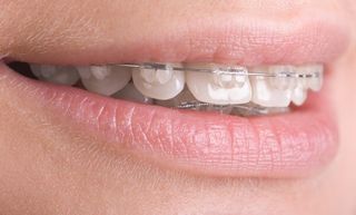Teeth with Braces — Cosmetic Dentistry in Hemet, CA Teeth with Braces — Cosmetic Dentistry in Hemet, CA