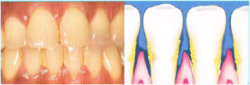 Gum disease explanation — Periodontics in Hemet, CA Gum disease explanation — Periodontics in Hemet, CA