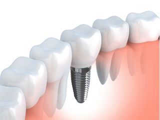 Replacing a missing tooth — Periodontics in Hemet, CA Replacing a missing tooth — Periodontics in Hemet, CA