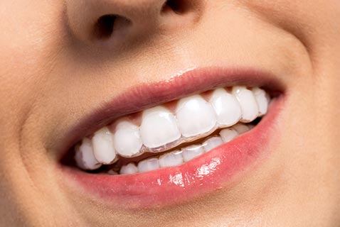 Smiling Girl Wearing Invisible Teeth Braces — Orthodontist in Hemet, CA Smiling Girl Wearing Invisible Teeth Braces — Orthodontist in Hemet, CA