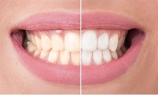 Teeth Whitening — Cosmetic Dentistry in Hemet, CA Teeth Whitening — Cosmetic Dentistry in Hemet, CA