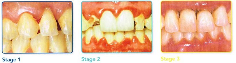 Gum disease picture — Periodontics in Hemet, CA Gum disease picture — Periodontics in Hemet, CA