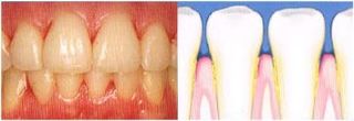 Ginggivitis — Periodontics in Hemet, CA Ginggivitis — Periodontics in Hemet, CA