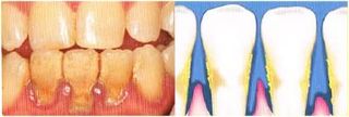 Advance Gum disease picture — Periodontics in Hemet, CA Advance Gum disease picture — Periodontics in Hemet, CA