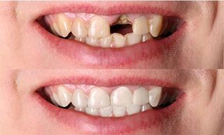 Tooth Restoration — Cosmetic Dentistry in Hemet, CA Tooth Restoration — Cosmetic Dentistry in Hemet, CA