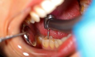 Placement of a Dental Inlay on a Cast Model Using a Tool — Cosmetic Dentistry in Hemet, CA Placement of a Dental Inlay on a Cast Model Using a Tool — Cosmetic Dentistry in Hemet, CA