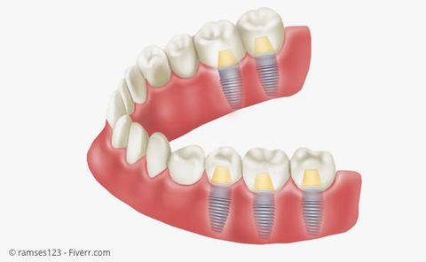 Implantate mit Kronen statt herausnehmbarem Zahnersatz Implantate mit Kronen statt herausnehmbarem Zahnersatz