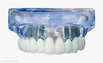 Mit mehreren Implantaten pro Kiefer können festsitzende Zähne anstelle von Totalprothesen gemacht werden. Mit mehreren Implantaten pro Kiefer können festsitzende Zähne anstelle von Totalprothesen gemacht werden.