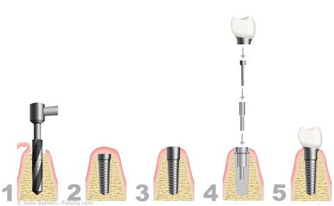 Ablauf einer Implantation Ablauf einer Implantation