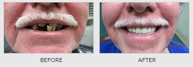 Old Man's Teeth Before - Dentistry in Lebanon, MO
