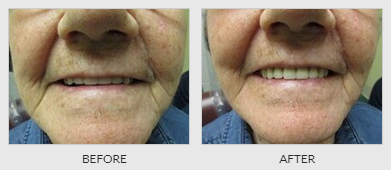 Old Lady's Teeth Before - Dentistry in Lebanon, MO