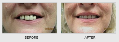 Denture Relining Before - Dentistry in Lebanon, MO