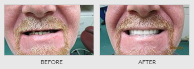 Denture Repair Before - Dentistry in Lebanon, MO