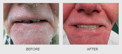 Denture Before - Dentistry in Lebanon, MO