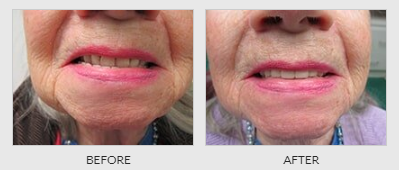Old Lady's Denture Repair Before - Dentistry in Lebanon, MO