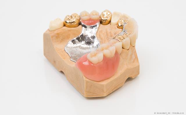 Wenn viele Zähne fehlen, können mit Implantaten herausnehmbare Teilprothesen vermieden werden. Wenn viele Zähne fehlen, können mit Implantaten herausnehmbare Teilprothesen vermieden werden.