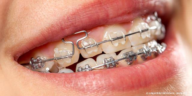 Festsitzende Zahnspange mit transparenten Brackets Festsitzende Zahnspange mit transparenten Brackets