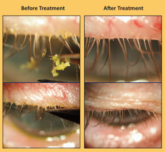 Blepharitis symptoms