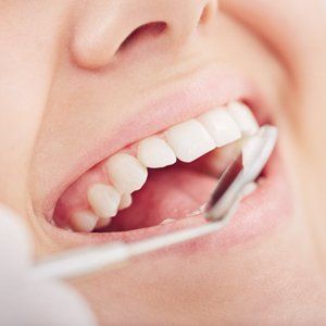 Invisible braces