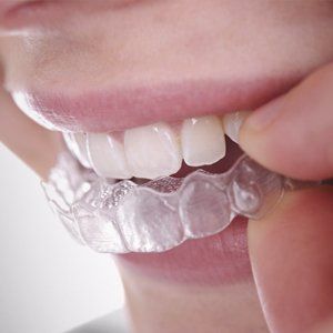 invisible braces