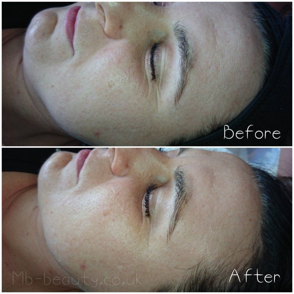 microdermabrasion