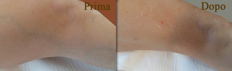 terapia sclerosante