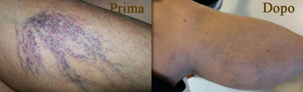 risultati con terapia sclerosante catania